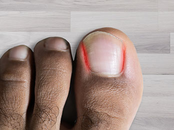 Ingrown Toenails in the Hillsborough County, FL: Tampa (Brandon, Town N Country, Greater Carrollwood, Temple Terrace, Westchase, Greater Northdale, Thonotosassa, Lake Magdalene, University, Egypt Lake-Leto, East Lake-Orient Park, Mango) areas