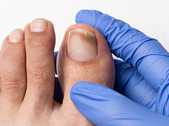 Fungal Toenails in the Hillsborough County, FL: Tampa (Brandon, Town N Country, Greater Carrollwood, Temple Terrace, Westchase, Greater Northdale, Thonotosassa, Lake Magdalene, University, Egypt Lake-Leto, East Lake-Orient Park, Mango) areas